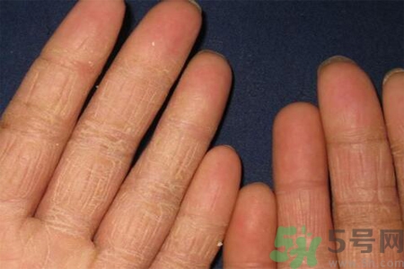 手足癬的治療方法？治療手足癬可以用什么藥？