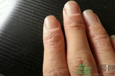 手足癬的治療方法？治療手足癬可以用什么藥？