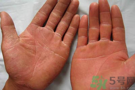 手足癬的治療方法？治療手足癬可以用什么藥？