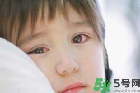 寶寶為什么會感染紅眼病？寶寶患紅眼病如何治療？