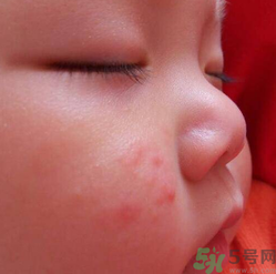 寶寶長(zhǎng)蘚是怎么回事？寶寶長(zhǎng)蘚怎么辦？