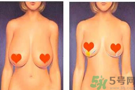 ?女性乳房下垂的原因是什么？女性乳房下垂的分類有哪些？