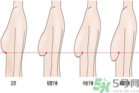 ?女性乳房下垂的原因是什么？女性乳房下垂的分類有哪些？