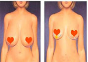 ?女性乳房下垂的原因是什么？女性乳房下垂的分類(lèi)有哪些？