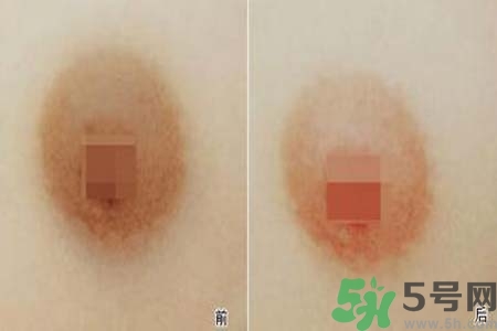 乳頭發(fā)黑怎么辦？怎么樣可以使乳頭變白？