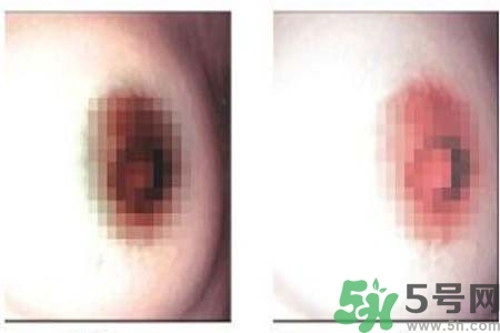 乳頭發(fā)黑怎么辦？怎么樣可以使乳頭變白？