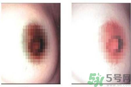 乳頭發(fā)黑是怎么回事？乳頭發(fā)黑是什么原因？