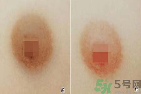 乳頭發(fā)黑是怎么回事？乳頭發(fā)黑是什么原因？