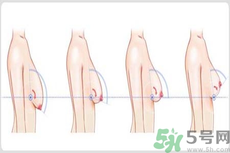 胸部松弛的原因是什么？胸部松弛該怎么辦？