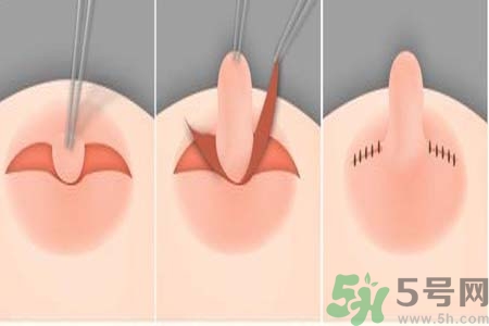 乳頭內(nèi)陷怎么回事？乳頭內(nèi)陷的原因是什么？