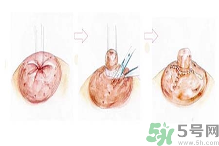 乳頭內(nèi)陷怎么回事？乳頭內(nèi)陷的原因是什么？