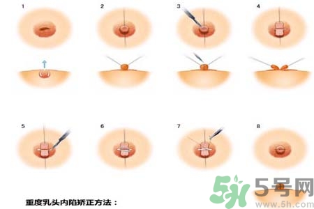 乳頭內(nèi)陷怎么回事？乳頭內(nèi)陷的原因是什么？