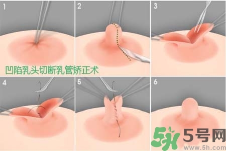 乳頭內(nèi)陷怎么辦？乳頭內(nèi)陷的癥狀有哪些？