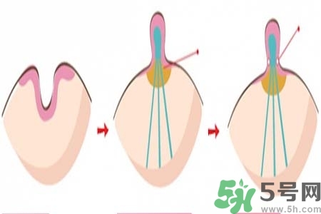乳頭內(nèi)陷怎么辦？乳頭內(nèi)陷的癥狀有哪些？