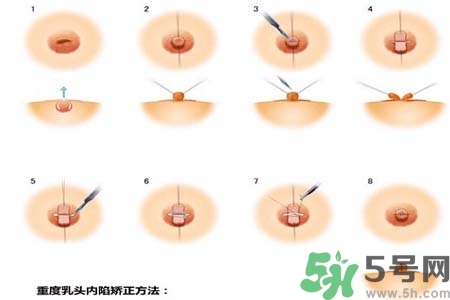 乳頭內(nèi)陷怎么辦？乳頭內(nèi)陷的癥狀有哪些？