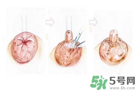乳頭內(nèi)陷怎么辦？乳頭內(nèi)陷的癥狀有哪些？