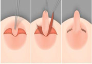 乳頭內(nèi)陷怎么辦？乳頭內(nèi)陷的癥狀有哪些？