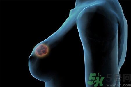 乳房屋硬塊有疼痛感怎么回事？乳房屋硬塊有疼痛感怎么辦？