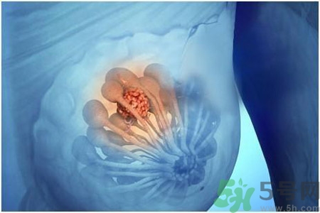 乳房屋硬塊有疼痛感怎么回事？乳房屋硬塊有疼痛感怎么辦？