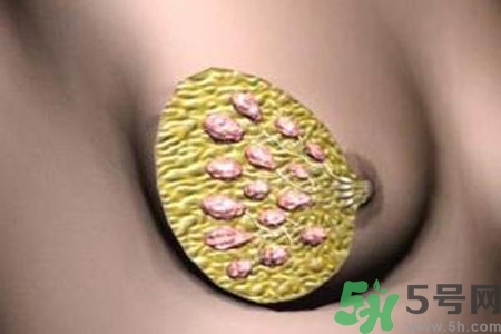 乳腺增生鈣化是什么？乳腺鈣化的癥狀有哪些？