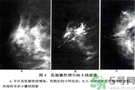乳腺增生鈣化是什么？乳腺鈣化的癥狀有哪些？