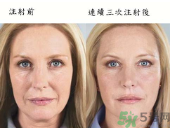 3D液態(tài)拉皮多少錢？3D液態(tài)拉皮后多久見效？