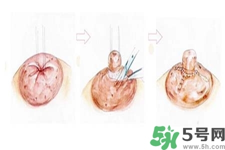 乳頭內(nèi)陷怎么矯正？乳頭內(nèi)陷矯正方法是什么？