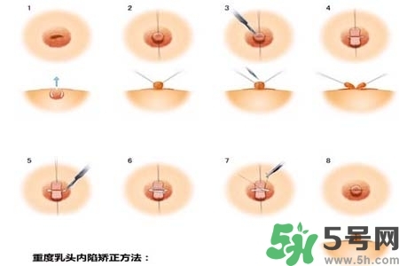 乳頭內(nèi)陷怎么矯正？乳頭內(nèi)陷矯正方法是什么？