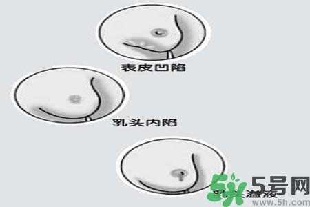 乳頭內(nèi)陷怎么矯正？乳頭內(nèi)陷矯正方法是什么？