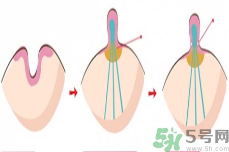 乳頭內(nèi)陷矯正需注意什么？乳頭內(nèi)陷如何預(yù)防？