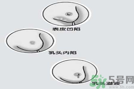 乳頭內(nèi)陷矯正需注意什么？乳頭內(nèi)陷如何預(yù)防？