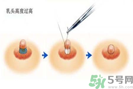 乳頭內(nèi)陷能不能喂奶？乳頭凹陷怎樣哺乳？