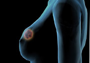 哺乳期乳房有硬塊疼痛怎么辦？如何預(yù)防哺乳期乳房有硬塊？