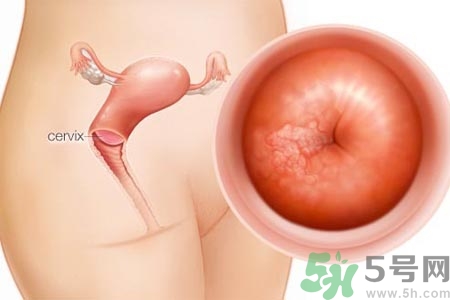 陰道松弛是什么？陰道松弛的癥狀有哪些？