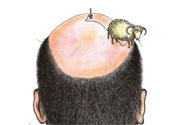 禿頂會(huì)遺傳嗎？治療禿頂?shù)姆椒ㄊ鞘裁矗?><p><strong>禿頂會(huì)遺傳嗎？治療禿頂?shù)姆椒ㄊ鞘裁矗?/strong></p></a></li> </ul>
</div>
<div   id=