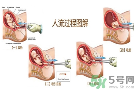 人工流產(chǎn)后多久可以再次懷孕？流產(chǎn)后需要注意什么？