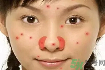 鼻翼長痘痘怎么回事？鼻翼長痘痘的原因是什么？