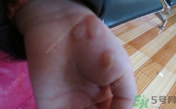 15歲還會得手足口病嗎？手足口病的癥狀有哪些？