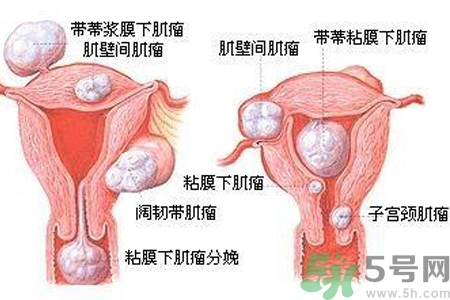 ?子宮移位怎么治療？子宮移位能懷孕嗎？
