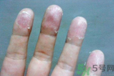 ?手掌脫皮的危害有哪些？如何預(yù)防手掌脫皮？