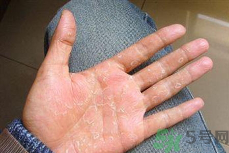 ?手掌脫皮的危害有哪些？如何預(yù)防手掌脫皮？