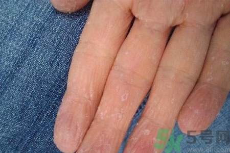 ?手掌脫皮的危害有哪些？如何預(yù)防手掌脫皮？