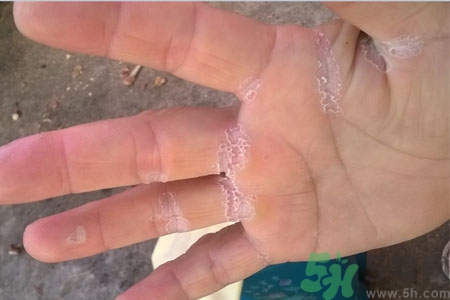 手脫皮是什么原因？手脫皮的治療方法是什么？