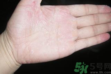 手脫皮是什么原因？手脫皮的治療方法是什么？