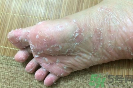 腳脫皮是怎么回事？腳脫皮怎么辦？