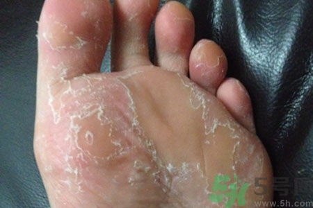 腳脫皮是怎么回事？腳脫皮怎么辦？