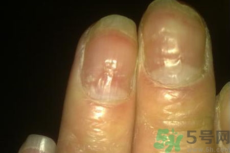 孩子手指甲凹凸不平是什么原因？手指甲凹凸不平的原因是什么？