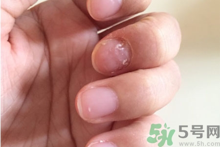 孩子手指甲凹凸不平是什么原因？手指甲凹凸不平的原因是什么？