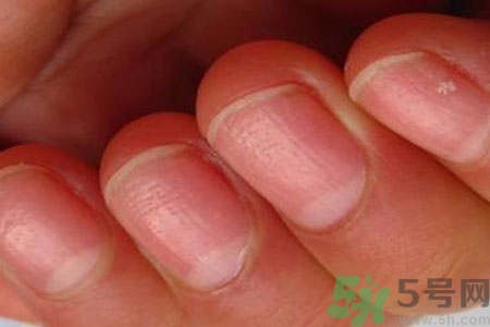 手指甲凹凸不平是怎么回事？如何預(yù)防手指甲凹凸不平？