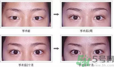 提眉術(shù)后多久可以恢復(fù)？提眉術(shù)后全過程照片